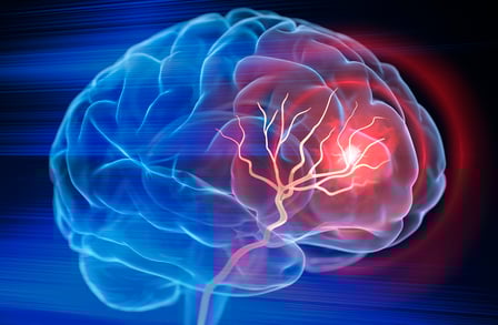 Brain stroke stock photo - iStockPhoto - Credit: peterschreiber.media