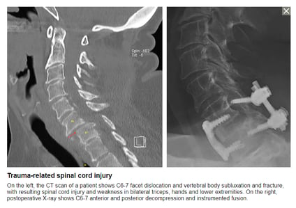 Trauma-related spinal cord injury