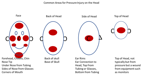 Pressure Injury on Head