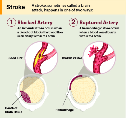 Stroke infographic