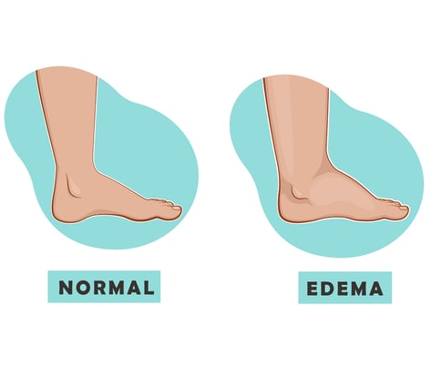 A swollen foot and ankle and a normal foot. Vector illustration of the disease.