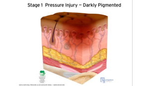 Pressure Injury Graphic - darkly pigmented