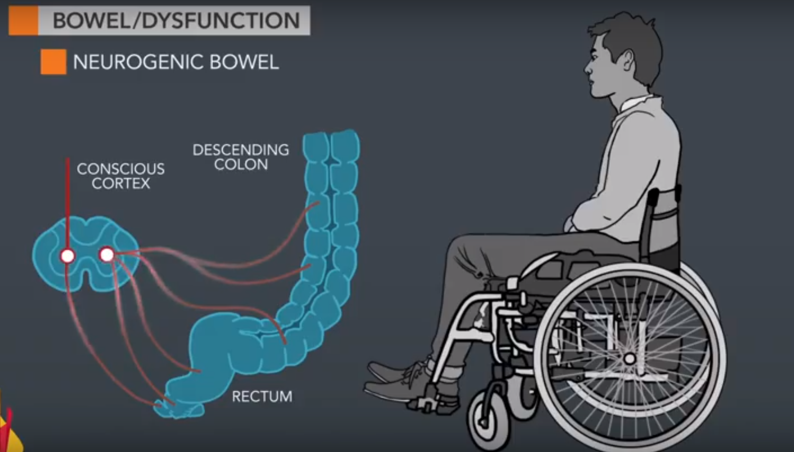 Neurogenic Bowel Infographic