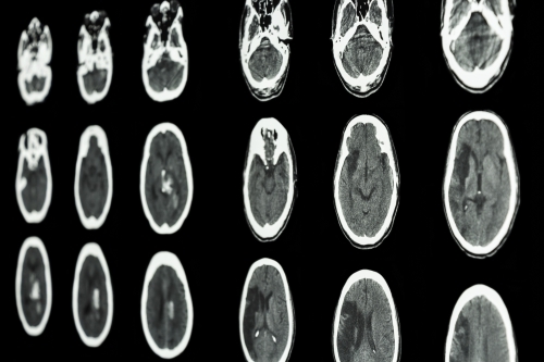 brain scans