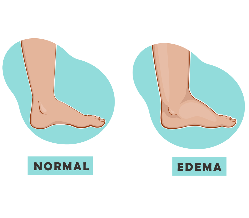 A swollen foot and ankle and a normal foot. Vector illustration of the disease